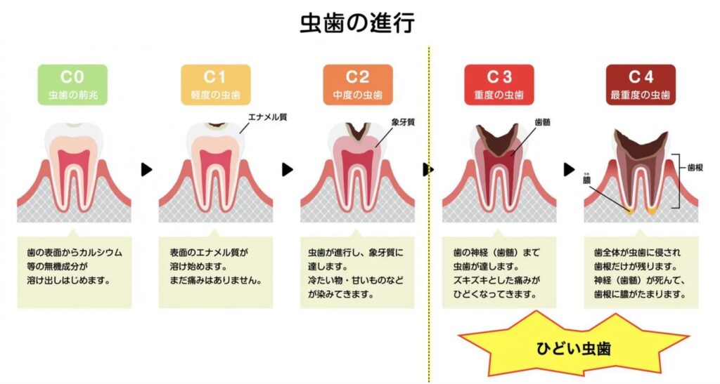 虫歯の進行 