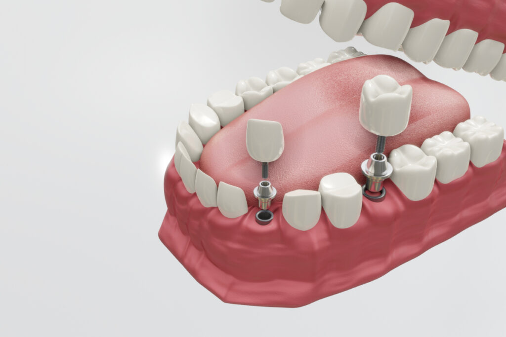 インプラント構造をしめす歯の模型