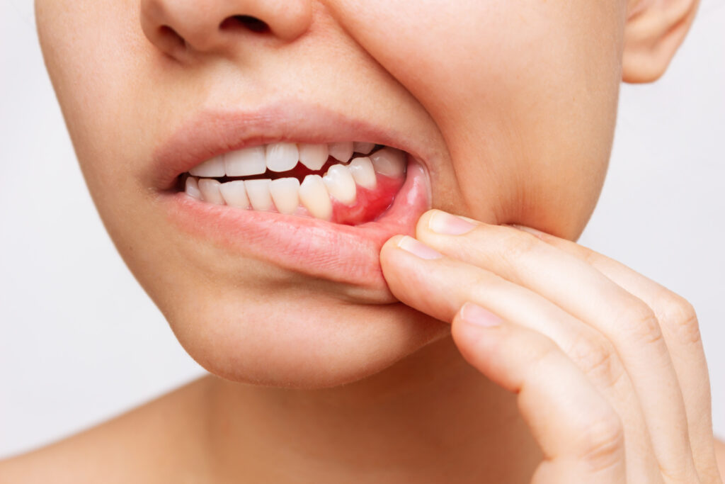 唇をめくって赤く腫れた歯茎を見せる女性