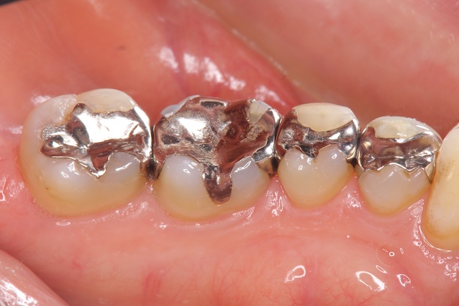 銀歯の治療