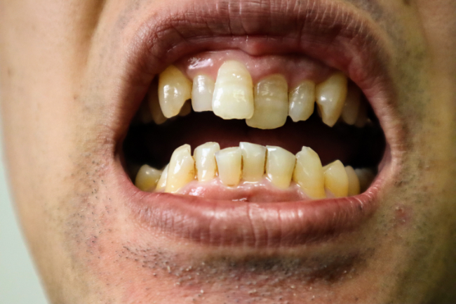 顎関節症を引き起こす可能性のある歯並び