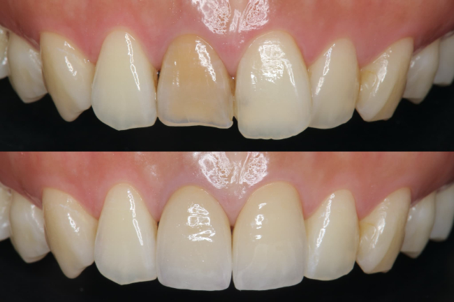 前歯をラミネートべニアで治療した前後のイメージ