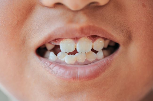 受け口の子どもの歯並び