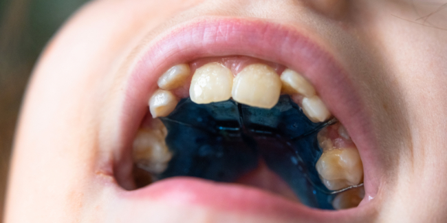 床矯正の装置を装着した口腔内