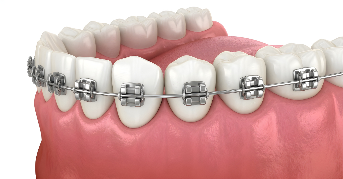 ワイヤー矯正治療している歯