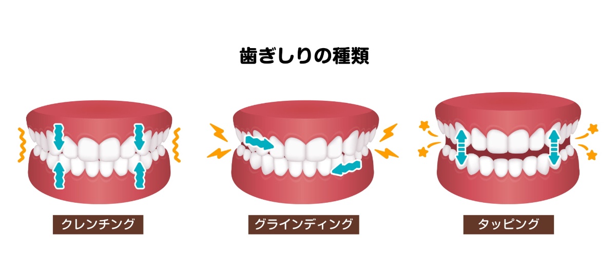歯ぎしりの種類を記した図