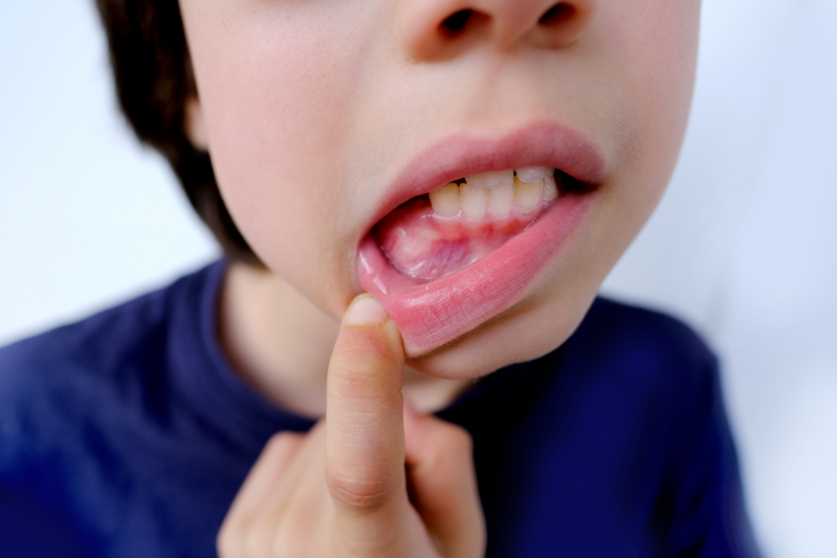子どもがかかる歯周病の種類の1つである歯肉炎