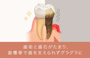 歯垢と歯石がたまり、歯槽骨で歯を支えられずグラグラに