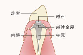 アタッチメント義歯