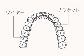 リンガルブラケット（舌側矯正）