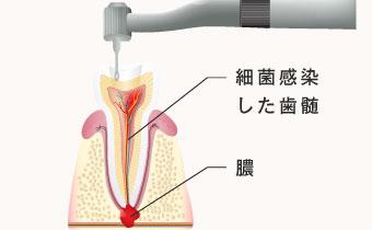 細菌感染した歯髄/膿