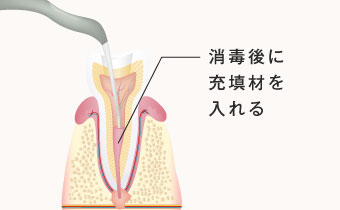 消毒後に充填剤を入れる