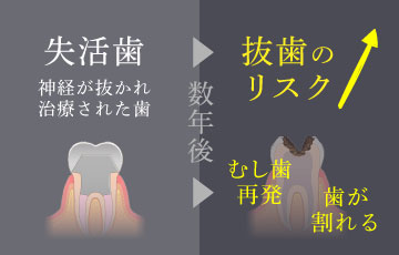 神経が抜かれ治療された歯は、数年後に虫歯が再発・歯が割れるなどで抜歯のリスクが高い