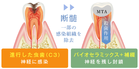 神経に感染した虫歯(C3)を断髄により神経を残したまま封鎖